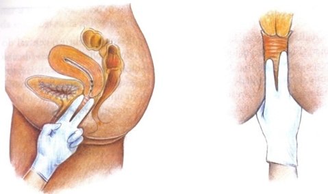 Desenho ilustrativo de toque vaginal realizado por fisioterapeuta