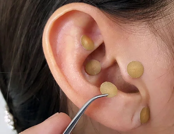 Auriculoterapia sendo realizada na orelha de uma mulher