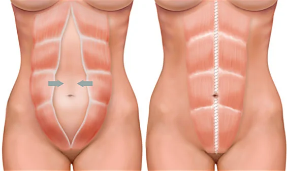 Desenho ilustrativo comparando a diástase abdominal feminina com um abdome normal