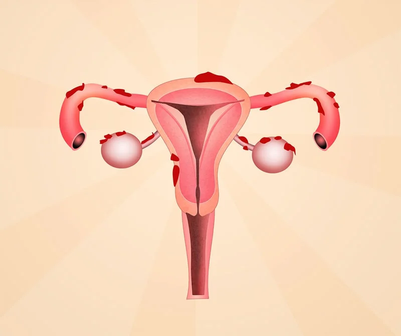 Desenho que mostra a endometriose com ovários policísticos