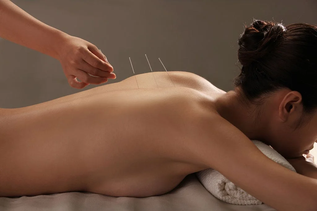 Mulher deitada bruços com agulhas de acupuntura nas contas